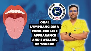 Dr Rudra Mohan  Oral Lymphangioma of the Tongue  Frog Egg like Appearance amp Swelling of theTongue [upl. by Buchheim91]