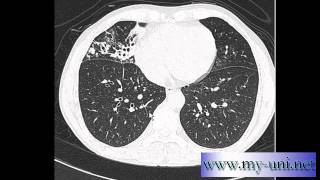 CT Chest  How to differentiate between pulmonary arteries and veins [upl. by Langer]