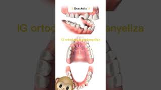 Extractions in orthodontics orthodontictips ортодонтия kieferorthopädie ortodonzia orthodontie [upl. by Laden916]