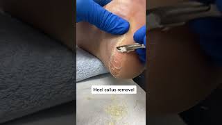 Uncover smooth skin underneath Watch how an Australian podiatrist tackles hard heel callus [upl. by Ennagrom]