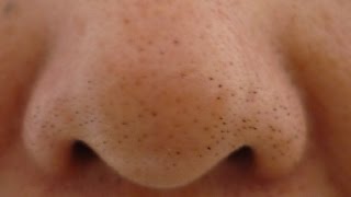 Blackheads  Home remedies for Blackheads  Open comedones [upl. by Vidda]