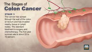 Stages of Colon Cancer [upl. by Bowe]