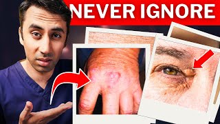 Doctor Explains 4 Skin Signs of High Cholesterol Real Life Photos [upl. by Ahsas]