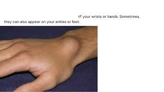 Ganglion Cysts Causes Symptoms and Treatment Optionsquot [upl. by Agan]