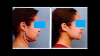 Sculpt the Chin amp Neck With Liposuction  Dr Sterry Explains [upl. by Erodroeht]