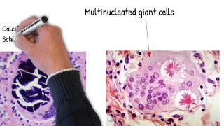 Sarcoidosis easy explained causes mechanism and pathology [upl. by Ziza]