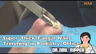 Super Thick Fungal Nails Trimming in Podiatry Office [upl. by Ahsenac]