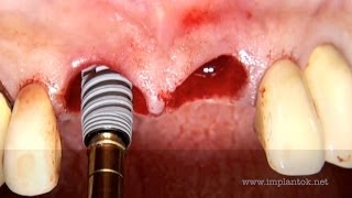 Immediate tooth replacement Nobel ActiveNobel Biocare [upl. by Morey]