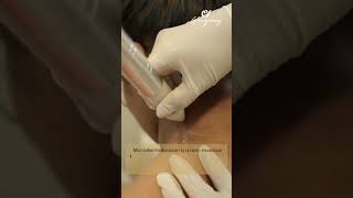 𝐃𝐚𝐫𝐤 𝐍𝐞𝐜𝐤  microdermabrasion Treatment  Neck pigmentation darknecktreatment darkneck [upl. by Yelnats]