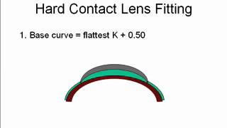 Lecture 17 Hard Contact Lenses [upl. by Eilhsa]