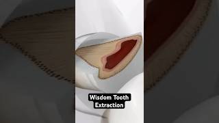 Wisdom Tooth Extraction 3D Animation [upl. by Eselehs]