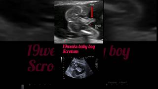 19weeks baby boy scrotum development shortsfeed pregnancy ultrasound [upl. by Alicul712]