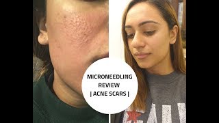 MICRONEEDLING REVIEW  Acne Scars  Before and After  PART 1 [upl. by Eloken]