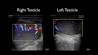 Global Ultrasound Institute Orchitis and Epididymitis on Point of Care Ultrasound [upl. by Akoek]