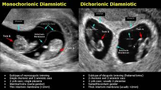 Fetal Twins Ultrasound Normal Vs Abnormal  MonochorionicDichorionicDiamnioticMonoamniotic USG [upl. by Obbard]