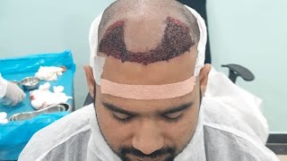 MorF 5 Minoxidil Hair Growth Solution after Hair Transplant Fail Results [upl. by Mallen715]