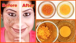 Remove Dark Spots From Skin Naturally  Anti Freckle Treatment [upl. by Ajed959]