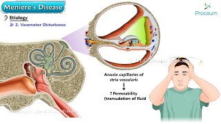 Menieres Disease 🌀  ENT Lectures [upl. by Alben]