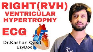 Right Ventricular Hypertrophy RVH on ECG Causes of RVH ECG EKG Dr Kashan Qasit [upl. by Lunneta]