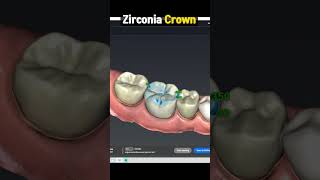 Zirconia Crown Procedure Explained  Pros and Cons in 1 minute [upl. by Assiral214]