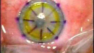 Lamellar Keratoplasty LK [upl. by Inessa313]