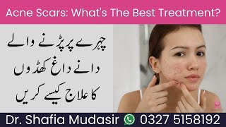 How to Get Rid of Acne Scars Treatments and Home Remedies Islamabad Rawalpindi Pakistan [upl. by Creath]