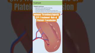 Immune Thrombocytopenia ITP Treatment Role of Platelet Transfusion immunethrombocytopenia itp [upl. by Sklar]