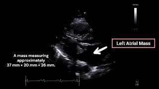 Left Atrial Mass [upl. by Glynnis]