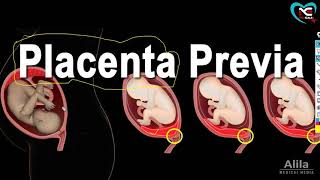 Placenta Previa Definition Cause Type Sign SymptomsFull Explanation in Hindi  By NG Medicals [upl. by Aivatnahs]