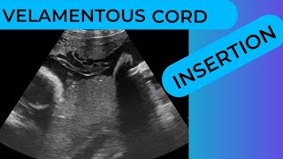 Velamentous Cord Insertion on Ultrasound Scan [upl. by Barrie]