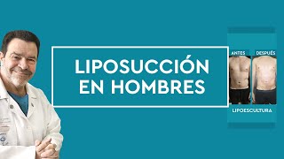 ¿Cómo es la liposucción en hombres [upl. by Aniral]