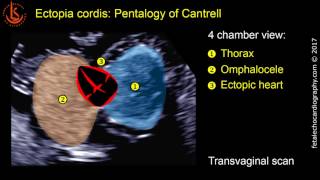 Fetal echocardiography at 1113 weeks Ectopia Cordis in Pentalogy of Cantrell [upl. by Orsino404]