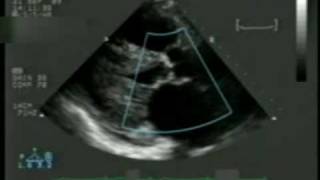 2D Echocardiogram with Doppler [upl. by Sherye]