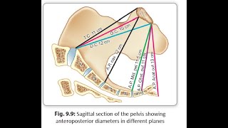 Obstetrics 121 Pelvis Pelvic Inlet Conjugate Diameter Anatomical True Obstetric Diagonal [upl. by Oecam]