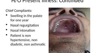 Case Presentation Adenoid cystic carcinoma of Minor salivary glads [upl. by Claudio]