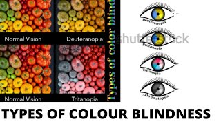 TYPES OF COLOUR BLINDNESS  PROTANOPIA TRITANOPIA DEUTERANOPIA [upl. by Rojas286]