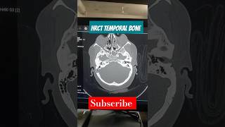 HRCT TEMPORAL BONE scan hrct temporal bone scan radiology ctscan ear earpain [upl. by Eyde]