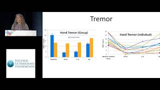 Diane Huss  Six year outcome of focused ultrasound thalamotomy for essential tremor 2018 [upl. by Alegna504]