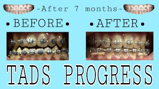 TADS PROGRESS  After 7 months😬🦷🪥 [upl. by Hooge494]