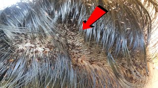 Extremely severe head lice combing from Beautiful long Hair [upl. by Aisena60]