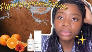 HYPERPIGMENTATION Pigmentflecken entfernen  Die Wissenschaft und alles was du wissen muss🌺 [upl. by Delmar]