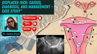 Displaced IUCD Causes Diagnosis and Management – Case Study healthytips DrSaimakhan [upl. by Kast908]