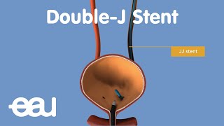 JJ Stent removal of kidney stones [upl. by Zanlog]