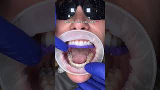 How we make bottom temporary smile before cementing permanent veneers teethclean 🦷beadrepair [upl. by Atikkin]