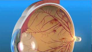 Retinopatía Diabética Proliferativa RDP [upl. by Nyleimaj]