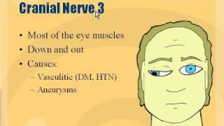 Neuro  Cranial Nerve 3 Palsy [upl. by Aneetsirk683]