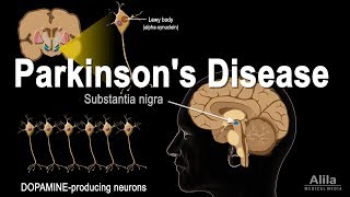 Parkinsons Disease Animation [upl. by Notrab896]