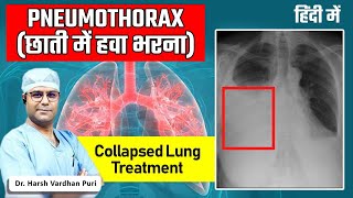 Pneumothorax छाती में हवा भरना  Collapsed Lung In Hindi  Case Study Of a Pneumothorax Patient [upl. by Huberty]