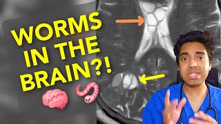 Worms in the BRAIN 🧠🪱 Doctor explains neurocysticercosis from undercooked pork 🐖 [upl. by Palmer]