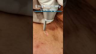 흑자제거 한번에 흑자제거skincare lentigovlog laser [upl. by Ailin547]